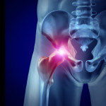 DePuy ASR Hip Replacement Settlement