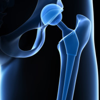Missouri Hip Replacement Missouri Hip Replacement