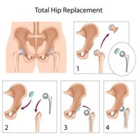 Images of a hip replacement Images of a hip replacement