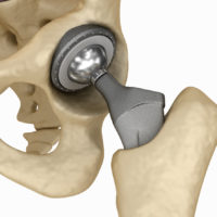 hip-implant-pic hip-implant-pic